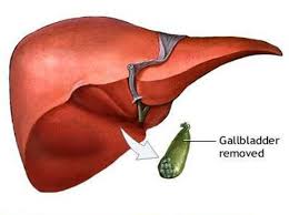 عوامل پارگی کیسه صفرا