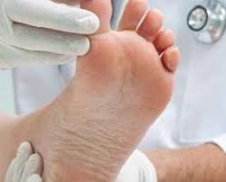 از علت تا درمان زخم پای دیابتی ها