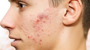 چرا آکنه می‌زنیم؟