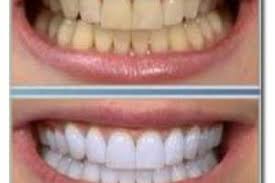 چگونه جرم دندان را بدون هزینه از بین ببریم؟