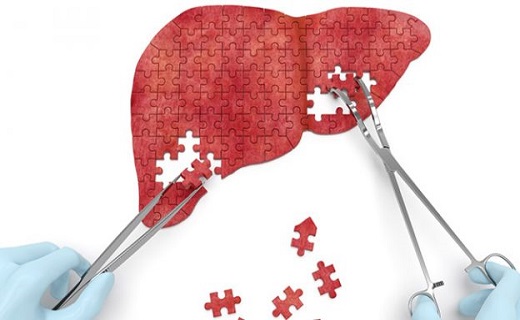 درمان کبد چرب با طب سنتی
