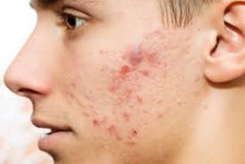 نبرد با آکنه با این داروی گیاهی