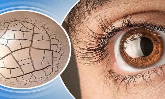 خشکی چشم درمان قطعی ندارد