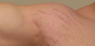 تَرَک‌های پوستی درمان دارد؟