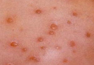 ویروس زونا از چه طریقی منتقل می‌شود؟