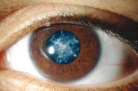 شایعترین بیماری‌های چشمی چیست؟