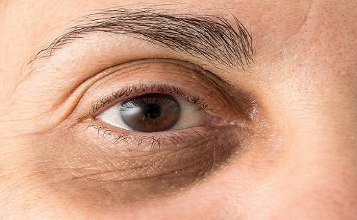 رهایی از تیرگی دور  چشم و پُف زیر چشم با طب سنتی