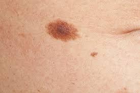 علائم هشداردهنده خال‌های بدن