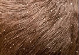 شوره سر می‌تواند نشانه چه باشد؟