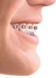 بهترین سن درمان تخصصی ارتودنسی در دختران و پسران