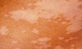 مرموزترین بیماری پوستی