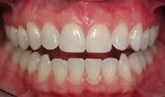 فرمول  غذایی برای داشتن لثه و دندان سالم