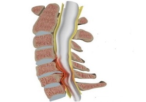 برنامه ورزشی برای مبتلایان به تنگی کانال نخاع گردنی