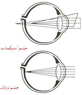 بهترین ویتامین ها برای درمان آستیگماتیسم
