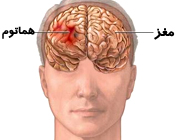 خون‌مردگي و کبودي پوست يا هماتوم مغزي
