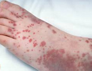 خون‌مردگي و کبودي پوست در پورپورا